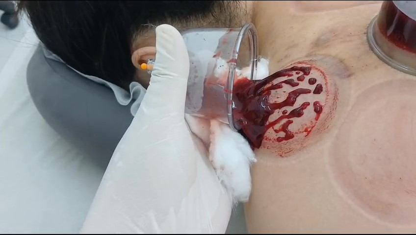 Cục Ứ Nghẹt gây đau vai gáy mãn tính